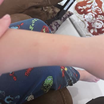 Çocuğumda Alerjik Reaksiyon Yaratan Saat Ücret İadesi Talebi