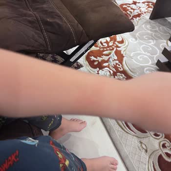 Çocuğumda Alerjik Reaksiyon Yaratan Saat Ücret İadesi Talebi