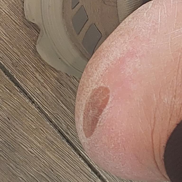 Crocs Terlikte Sağlık Sorunu, İade Ve Açıklama Talebi