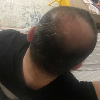 Batçı Hair Atelier Saç Kapatıcıda Akma Ve İade Talebi