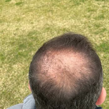 Batçı Hair Atelier Saç Kapatıcıda Akma Ve İade Talebi