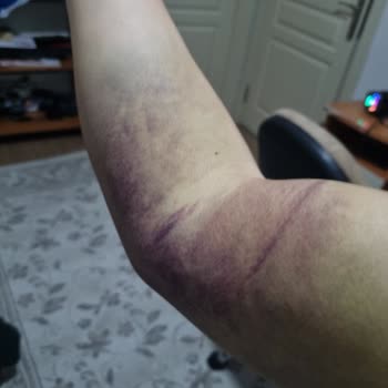 Türk Kızılay Kan Bağışı Sonrası Şiddetli Kol Ağrısı Ve Geniş Morluk