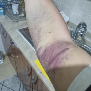 Türk Kızılay Kan Bağışı Sonrası Şiddetli Kol Ağrısı Ve Geniş Morluk