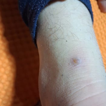 Ayak Ağrısına Neden Olan Ayakkabının Fiziksel İncelenmeden Görsel İncelemesi Sonrası İade Talebi