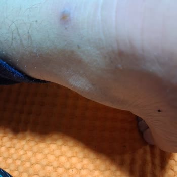 Ayak Ağrısına Neden Olan Ayakkabının Fiziksel İncelenmeden Görsel İncelemesi Sonrası İade Talebi