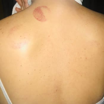 Özel Levent Hastanesi’nden Yarar Sağlamayan Fizik Tedavi Ücretinin İptali