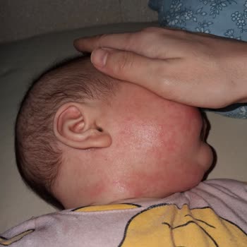 Mustela Stelatopia Kremi Bebeğimde Alerjik Reaksiyon Ve Cilt Kızarıklığına Neden Oldu