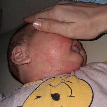 Mustela Stelatopia Kremi Bebeğimde Alerjik Reaksiyon Ve Cilt Kızarıklığına Neden Oldu