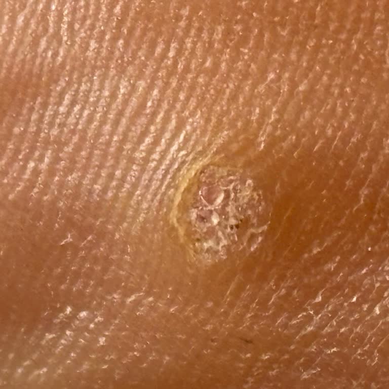 Yetersiz Havuz Hijyeni Nedeniyle HPV Virüsü Ve Siğil Mağduriyeti