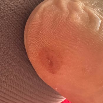 Limoya Ayakkabı Botun İç Kısmındaki Çivi Ayağıma Battı ve Ayağım Kanadı