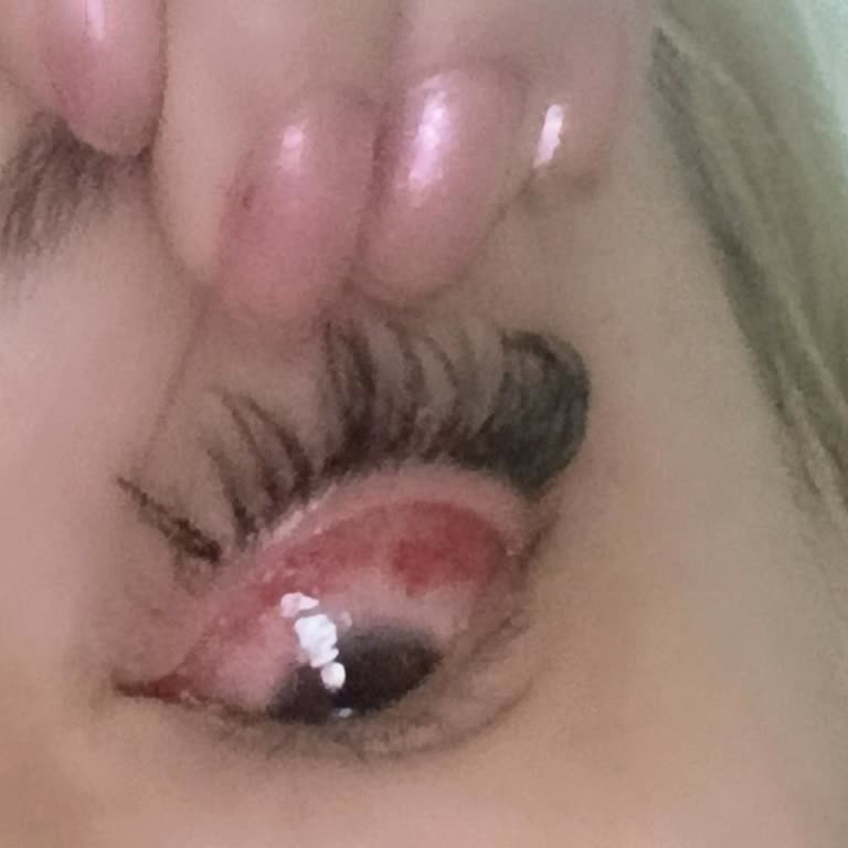 Sevda Güzellik | Gaziantep Kirpik İşlemi Sonrası Göz Enfeksiyonu Ve Fiziksel Şiddet