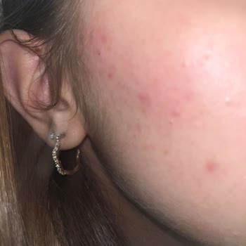 Allık Ve Bronzer Kullanımından Sonra Şiddetli Sivilce Belirdi