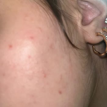 Allık Ve Bronzer Kullanımından Sonra Şiddetli Sivilce Belirdi