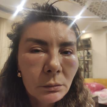 Gözaltı Dolgu Sonrası Ciddi Deformasyon Ve Ağrı