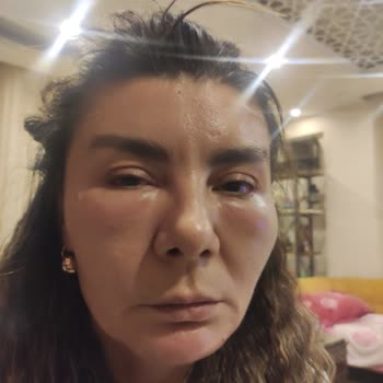 Gözaltı Dolgu Sonrası Ciddi Deformasyon Ve Ağrı