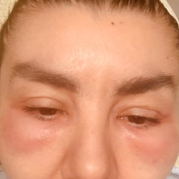 Gözaltı Dolgu Sonrası Ciddi Deformasyon Ve Ağrı