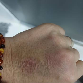 Kocaeli Atakent Cihan Hastanesi Acilde Damar Yolu Açma Hatası Ve Saygısız Tutum