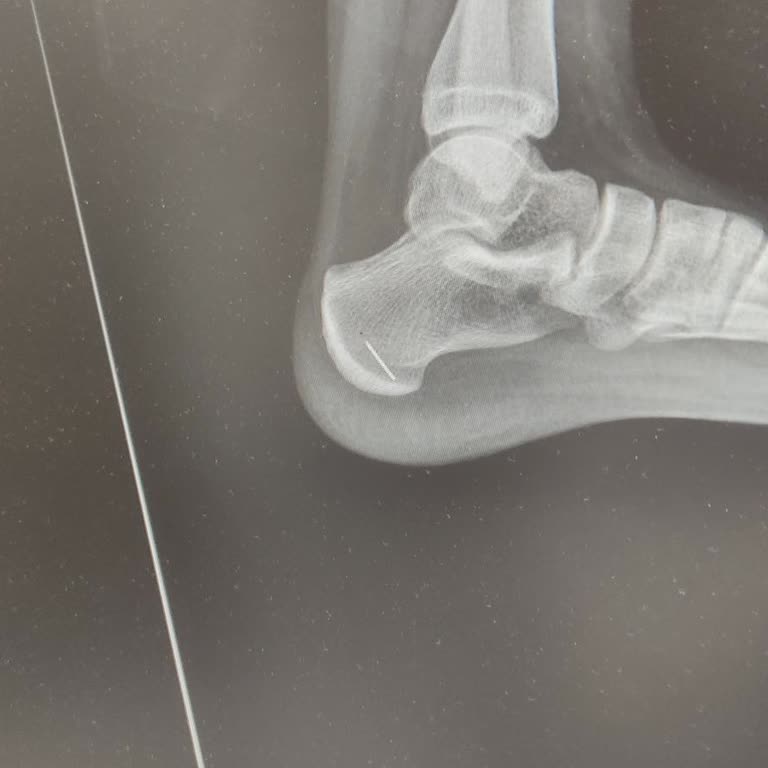 Bayrampaşa Kolan Hastanesi'nde Görüntüleme İhmali Çocuğun Ayağında İğne Kalmasına Neden Oldu