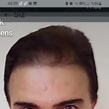 Estecenter Saç Ekimi Sözleşme İhlali Ve Garanti Belgesi Verilmemesi