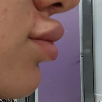 Yanlış Dudak Dolgusu İşlemi Sonrası Mağduriyet