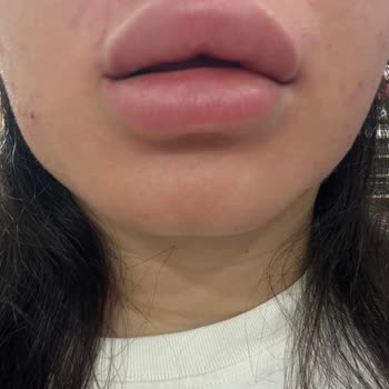 Yanlış Dudak Dolgusu İşlemi Sonrası Mağduriyet