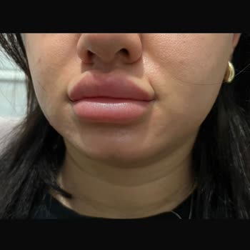 Yanlış Dudak Dolgusu İşlemi Sonrası Mağduriyet