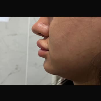 Yanlış Dudak Dolgusu İşlemi Sonrası Mağduriyet