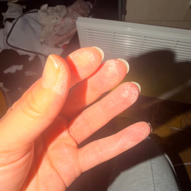 Vanish Kosla Cilt Yanığı Ve Uyarı Eksikliği