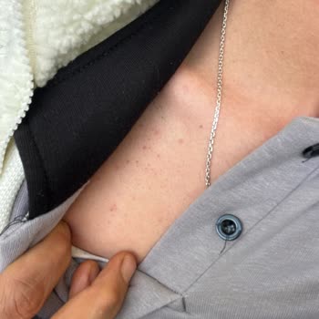 Tam Vücut Lazer Epilasyonunda Yanık Ve Kaşıntı Sonrası Hastaneye Yatış Ve Ücret İadesi Talebi