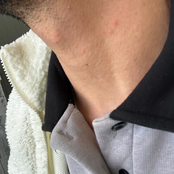 Tam Vücut Lazer Epilasyonunda Yanık Ve Kaşıntı Sonrası Hastaneye Yatış Ve Ücret İadesi Talebi