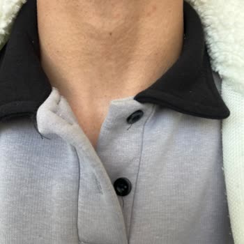 Tam Vücut Lazer Epilasyonunda Yanık Ve Kaşıntı Sonrası Hastaneye Yatış Ve Ücret İadesi Talebi