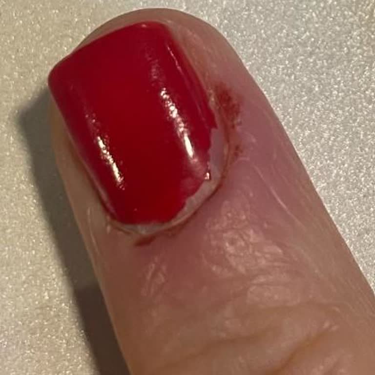 Manikür Sırasında Dikkatsizlik Ve Sonrası Cevapsızlık: Sağlık Sorunum Çözülmedi