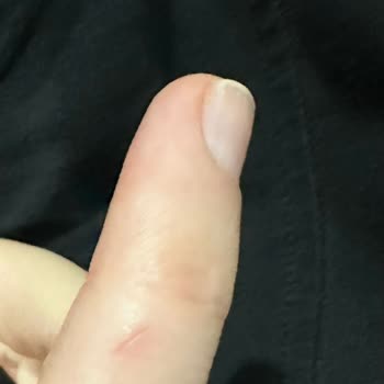 Kalıbı Açarken Ellerim Kesti, Kurye Gelmedi Ve İade Ücreti İstiyorlar