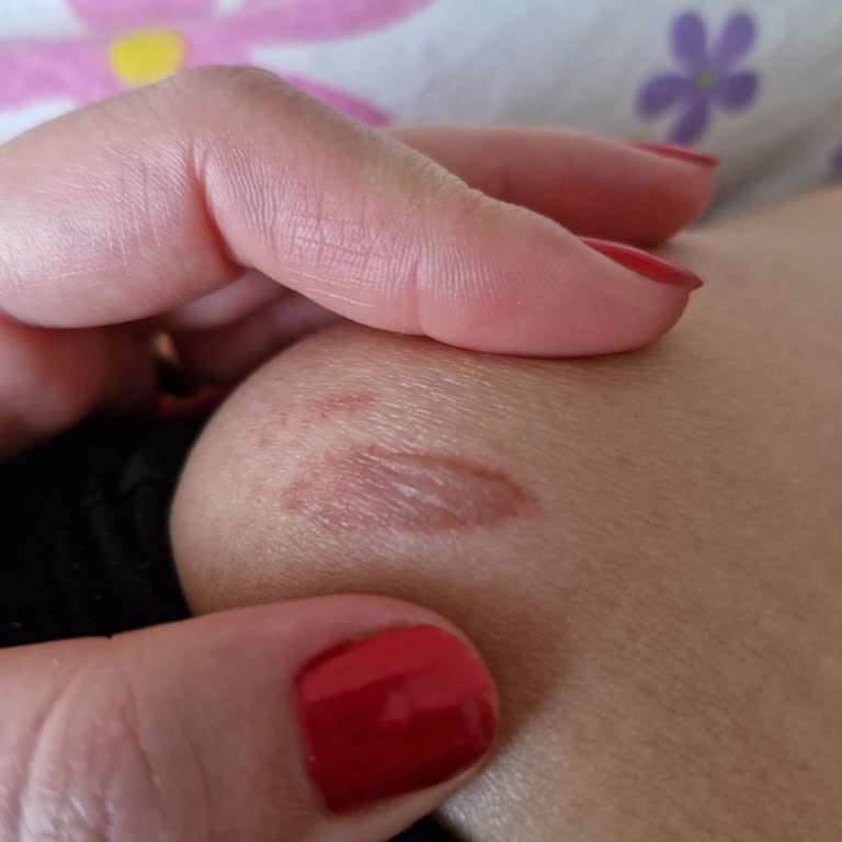 Zeer Lux Beauty Lunch'ta Lazer Epilasyonda Yanık Ve İhmal: Ücret İadesi Talebi