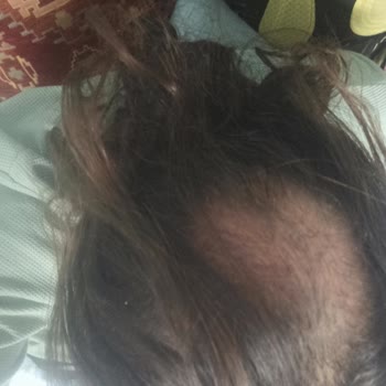 Ahmet Tektaş Hair Clinic Saç Ekimi Sonrası Greft Büyümemesi ve Takip Eksikliği