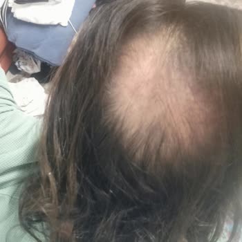 Ahmet Tektaş Hair Clinic Saç Ekimi Sonrası Greft Büyümemesi ve Takip Eksikliği