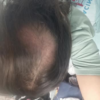 Ahmet Tektaş Hair Clinic Saç Ekimi Sonrası Greft Büyümemesi ve Takip Eksikliği