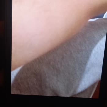 Kızımın Kol Şişmesi Ve Acil Servis Personelinin Yetersiz Açıklamaları