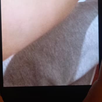 Kızımın Kol Şişmesi Ve Acil Servis Personelinin Yetersiz Açıklamaları