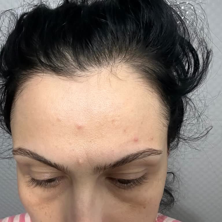 Yves Rocher Yüz Kremi Ve Serumda Şiddetli Sivilce Oluşumu