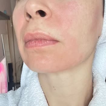 Kokusu Değişen Collagen Serumu Cilt Yanması Ve Kaşıntıya Yol Açtı