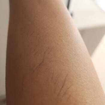 Yüzde 100 Zam Ve Sonuçsuz Lazer Epilasyon Şikayeti