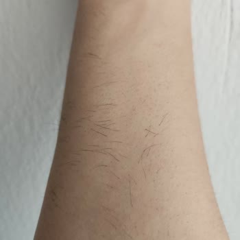 Yüzde 100 Zam Ve Sonuçsuz Lazer Epilasyon Şikayeti