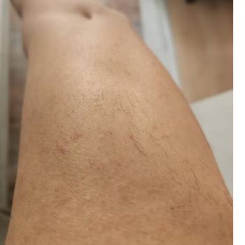 Yüzde 100 Zam Ve Sonuçsuz Lazer Epilasyon Şikayeti