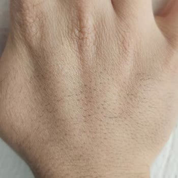 Yüzde 100 Zam Ve Sonuçsuz Lazer Epilasyon Şikayeti