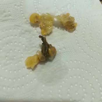 Tada Tam Tadında Mısırda Yabancı Cisim Ve Bakteri Benzeri Oluşumlar