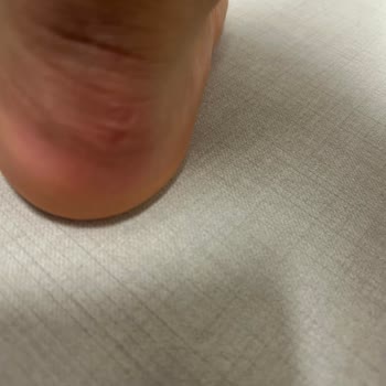 Zara Ayakkabısı Ayağımı Jilet Gibi Kesti Ve Sağlık Sorunu Yaratıyor