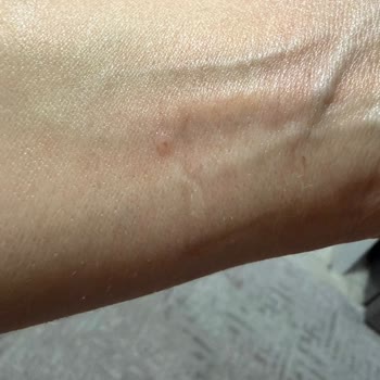 Yves Rocher Pure Algue Make Up Remover'de Şiddetli Alerjik Reaksiyon