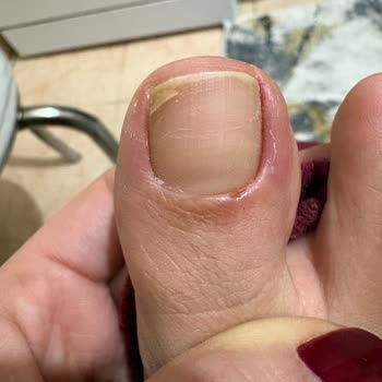 Hijyen Kurallarına Uymayan Güzellik Salonu İşlemi Sonrası Enfeksiyon