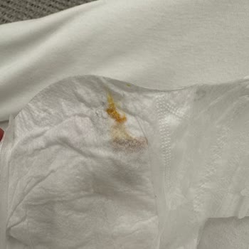 Bebek Bezinde Belirsiz Kalıntı: Güvenlik Ve İhmalkârlık Şikayeti